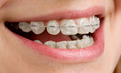 Clear (Ceramic) Braces - Miller Orthodontics